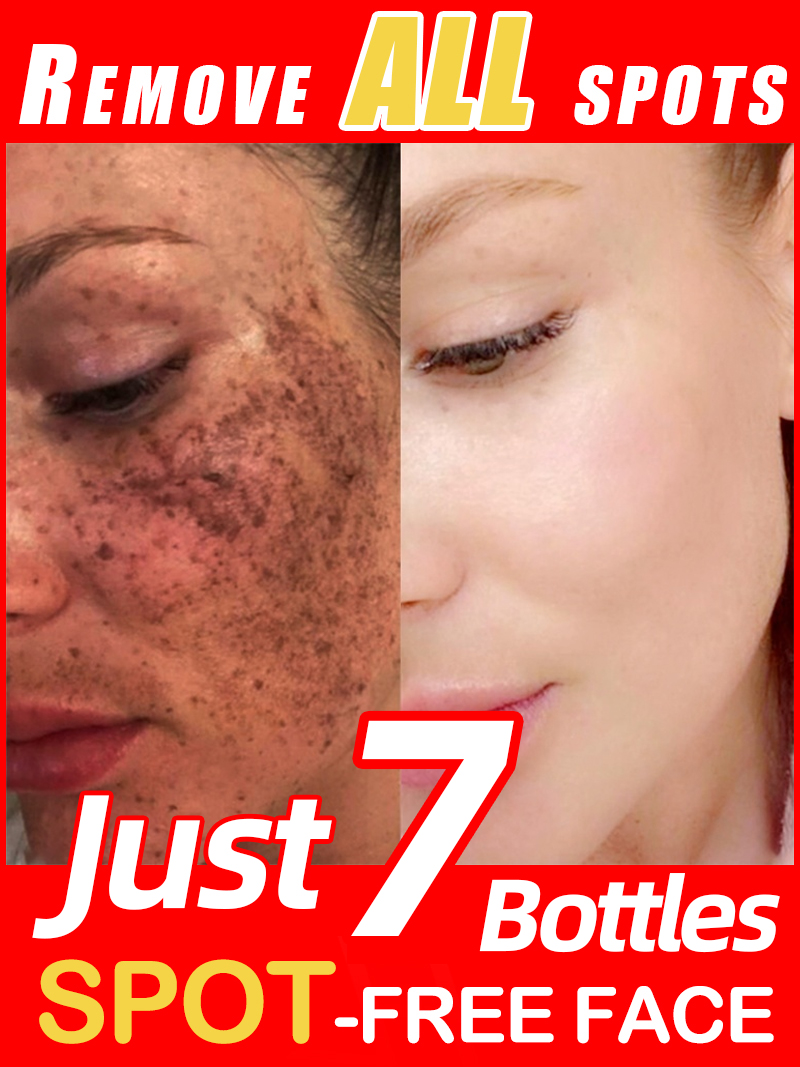 Lighten Freckles Melasma, Faci - Ultra Luxury Skincare review and price